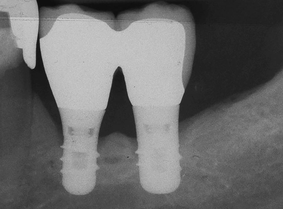 Fig. 4a: 1-year follow-up. Both implants are well integrated, no signs of bone loss