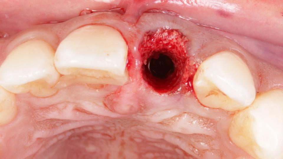 Abb. 8b: Typ-1-Implantation: Knochentransplantat in der bukkalen Lücke.
