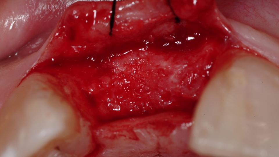 Fig. 10b: Préservation de la crête + pose d'un implant de type 4 : Cicatrisation idéale de la crête alvéolaire après la ROG.