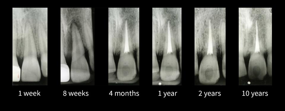 图3: 牙固连。左上中切牙撕脱损伤后10年随访的根尖片显示，牙根逐渐被牙槽骨所替代，并可见明显的下沉