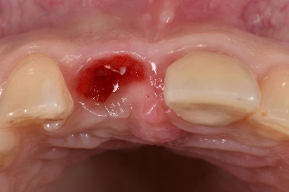 Fig. 20: The horizontal view 6 months after alveolar ridge preservation shows that minor tissue reduction has occurred