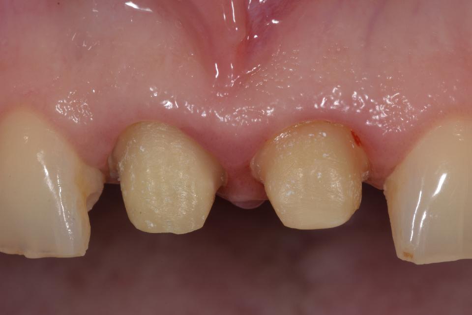 Fig. 12: Clinical situation with a failing central incisor due to an endodontic complication