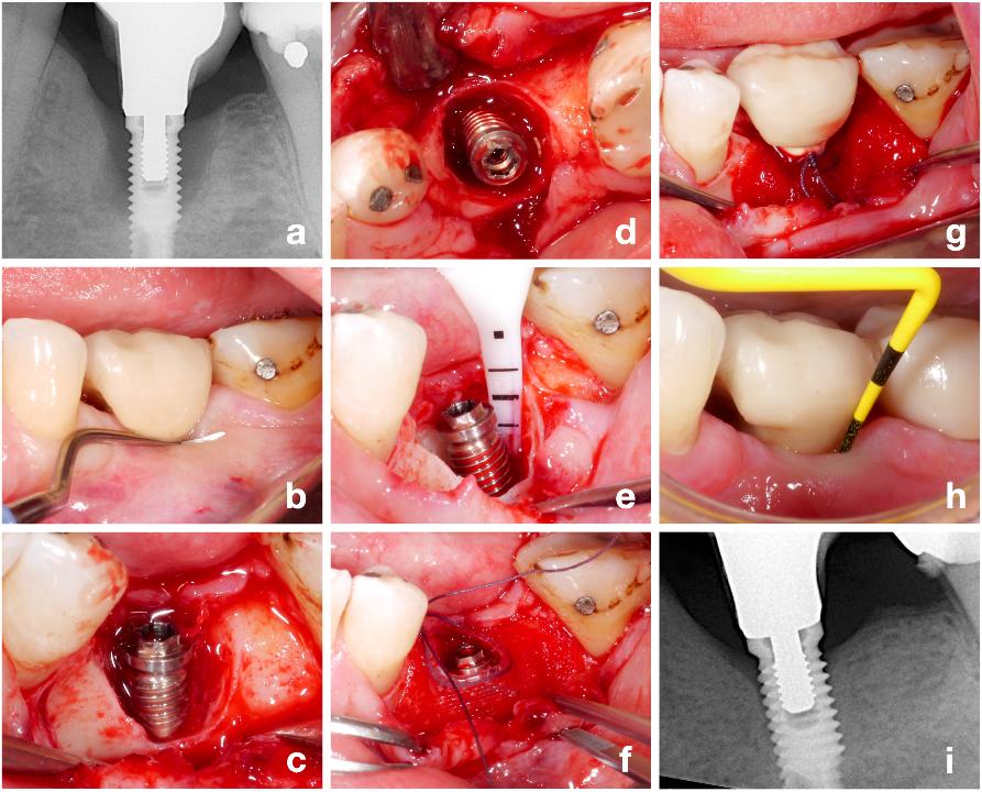 Fig. 5: Patient case with peri-implantitis at the implant in position #36 (a) and a prosthetic restoration with an unfavorable buccal emergence profile (b) treated by a reconstructive approach. After flap elevation a class Ic defect is recognized (c - d). Implant surface decontamination was performed with an air-polishing device (e) and the defect treated with a long-lasting resorbable membrane only (f - g). The procedure including modification of the prosthetic restoration resulted in a stable post-operative result (h) with a significant improvement in the crestal peri-implant bone level (i)