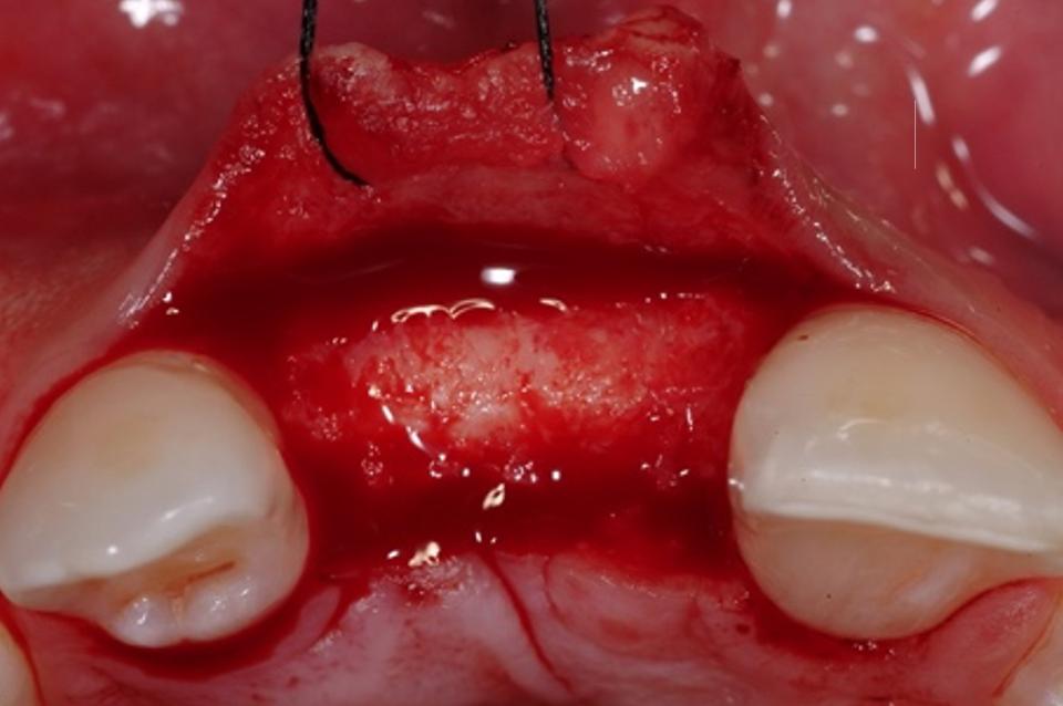 Resim. 7b: Tip 4  implant yerleştirme: İdeal alveolar sırt