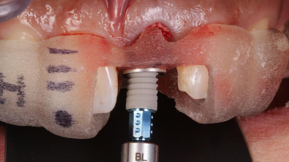 Fig. 8a: Pose d'un implant de type 1 : Pose guidée de l'implant dans l'alvéole d'extraction.