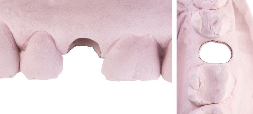 Fig. 3e: Modification of the pre-operative cast to receive the implant index and analog, with preservation of the gingival margin position of the extracted tooth