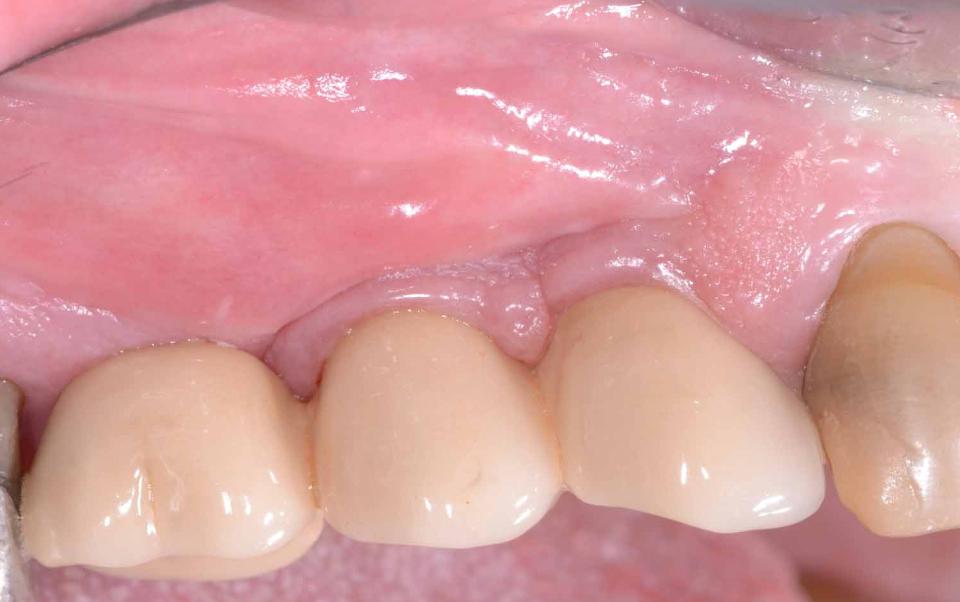 Fig. 6h: Clinical status at the 6-year follow-up. No additional implant was inserted. The two implant crowns were splinted and a distal cantilever unit added. The peri-implant soft tissues are healthy