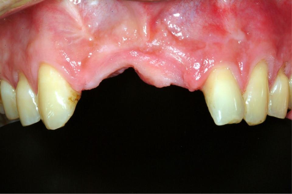 Fig. 4a: Preoperatory view, showing anterior maxilla vertical deficiency, secondary to trauma