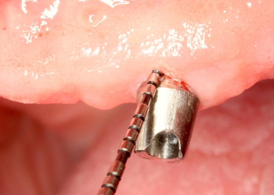 Fig. 2a: Peri-implant mucositis. Shallow probing depths of 3 mm with clinical signs of inflammation and bleeding on probing (BOP) at the buccal aspect of the implant