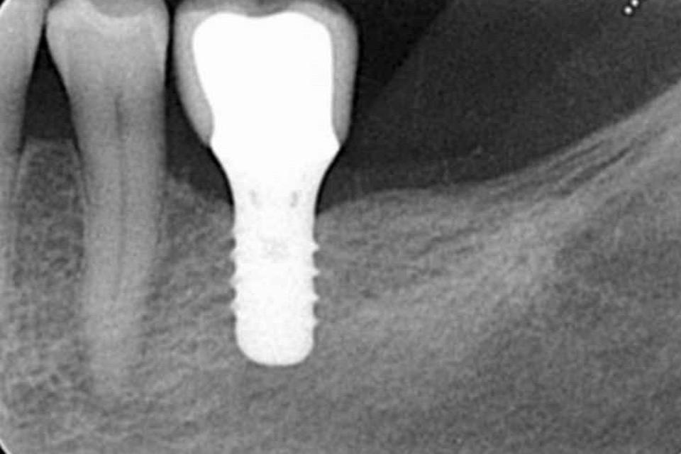 Fig. 4l: Radiographic image, taken at the 10-year follow-up, revealed the improvement of the interproximal bone levels