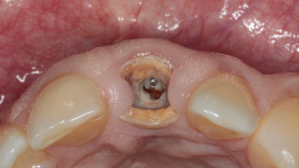 Fig. 3b: Tecnica minimamente invasiva per l'estrazione dei denti senza lembo – vista occlusale iniziale