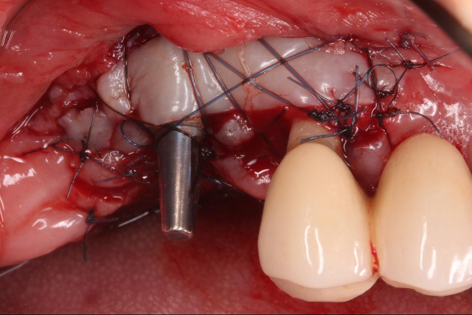 Fig. 3l: Enxerto gengival livre foi realizado após 6 meses de acompanhamento da cirurgia de ROG.