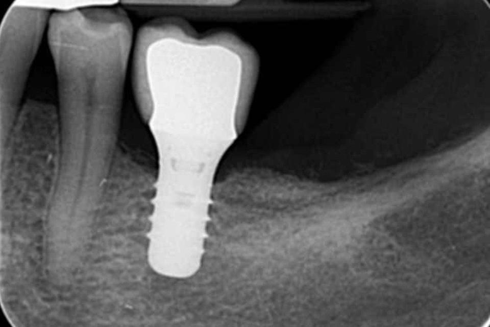 Fig. 4e: Radiographic image, taken in December 2010, showing a minimal interproximal bone loss