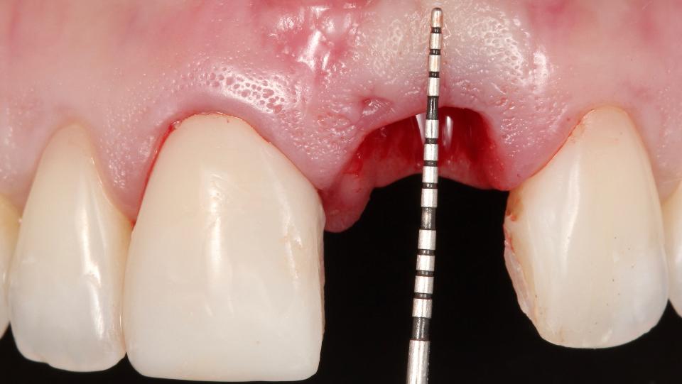 Abb. 2i: Minimalinvasives Verfahren zur lappenlosen Zahnextraktion – Aufsuchen der fazialen Knochenwand 4 mm apikal des Weichgewebesaums