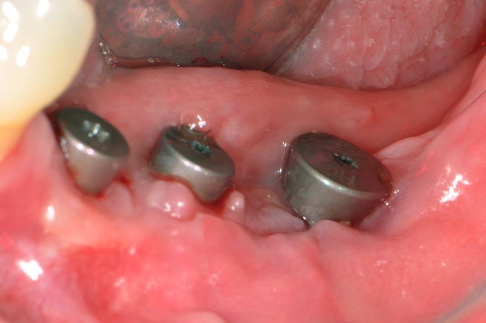 Fig. 4a: Une péri-implantite a été diagnostiquée sur l'implant n° 19. Une absence de muqueuse buccale kératinisée a également été constatée.