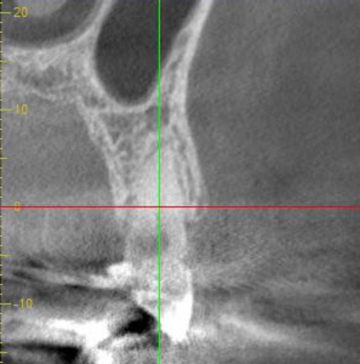 Fig. 6b: Cross-section CBCT view of the tooth indicated thick facial and palatal bone walls, and sufficient apical bone volume to place an implant. There was no periapical pathology