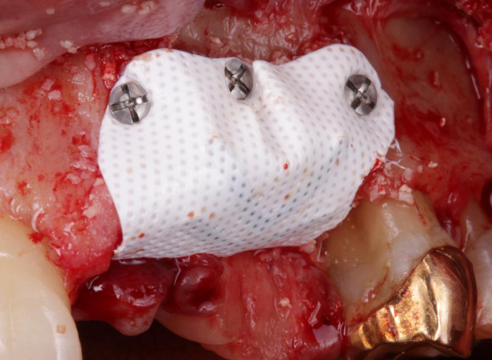 Fig. 12c: Enxerto ósseo horizontal e vertical + instalação de implante tipo 4: Membrana reforçada com titânio
