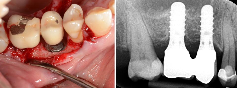 Fig. 1b: Caso de peri-implantite exibindo aumento da profundidade da bolsa de sondagem (> 6 mm, supuração e defeito ósseo em forma de pires)