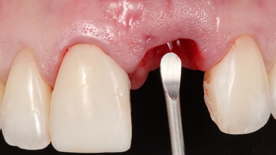 Fig. 2g: Tecnica minimamente invasiva per l'estrazione del dente senza lembo – rimozione del tessuto di granulazione della lesione periapicale con una curette chirurgica Lucas