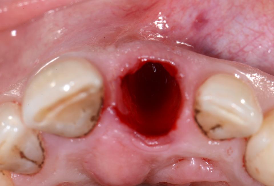 Fig. 5c: The conditions were therefore optimal for immediate (type 1) implant placement. Since the patient was not concerned about having a fixed tooth replacement after the extraction, the treatment plan was to undertake a conventional loading protocol following implant placement, according to the type 1C protocol. This image shows the situation after tooth extraction without flap elevation. Inspection of the socket confirmed that the bone walls were intact