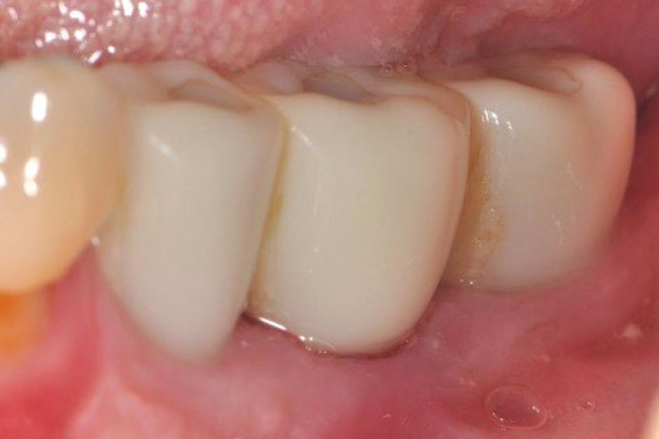 Fig. 4i: Subsequent 6-year post-GBR-surgery follow-up. The probing depths of all implants were stable and without bleeding on probing