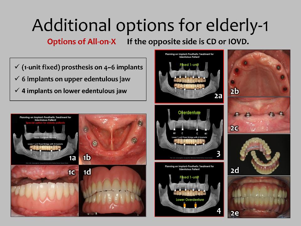 Fig. 7: Options of All-on-X. In developing the treatment plan, the first plan is to provide patients with a fixed prosthesis unless there are any adverse anatomical situations. Depending on the degree of alveolar bone resorption, a massive bone graft or enhancement surgery may be required. But, in general, implant treatment accompanied by excessive bone grafting or transplantation surgery are not recommended due to the weak systemic health of elderly disabled patients. As additional options for the elderly, a prosthetic design that allows hygiene to be managed not only by elderly patients themselves but also by caregivers or guardians (universal design, Leesungbok 2016). The choice of treatment options for elderly disabled patients should be based on the concept of universal design, a thoroughly patient-friendly perspective. Based on this, the All-on-X method, which provides a fixed prosthesis with the help of artificial gums while minimizing the number of implants, has recently received a lot of favorable responses for elderly disabled patients (1a - 1d, 2a - 2e, 3, and 4)