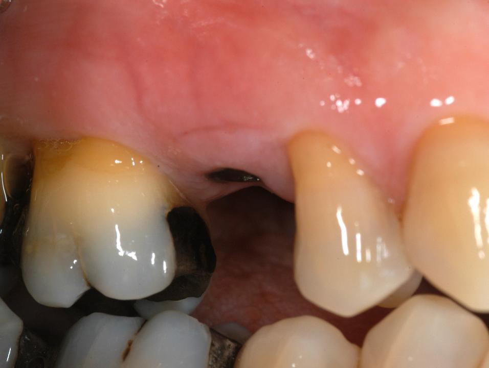 Fig. 4e: The facial view of the second premolar site 6 weeks after placement