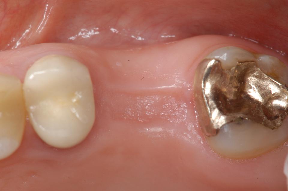 Fig. 8a: Single tooth gap in area 26 with a slight buccal flattening 6 months post-extraction