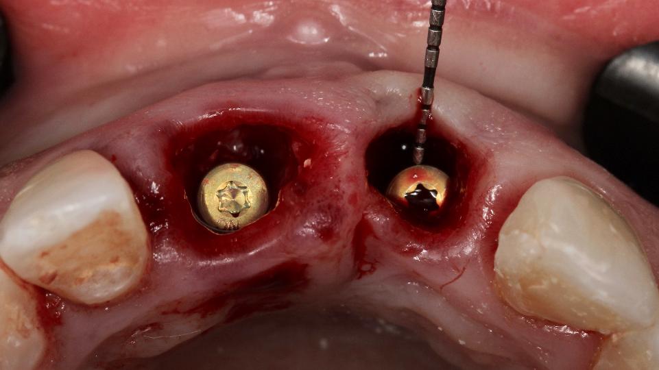 Fig. 6e: Type 1a protocol – region #21 – measurement of the distance between the implant surface and the facial bone wall (gap dimension) which is >2 mm