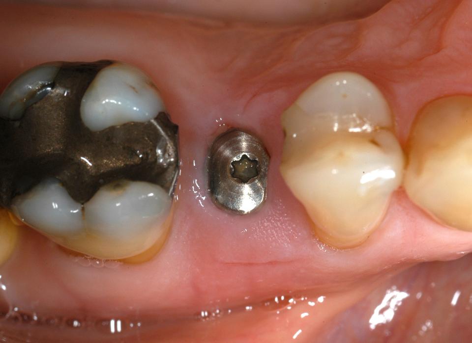 Fig. 4d: 6 weeks after placement, the peri-implant tissues were fully healed. Integration was confirmed by applying 35 Ncm of rotational torque to the healing cap