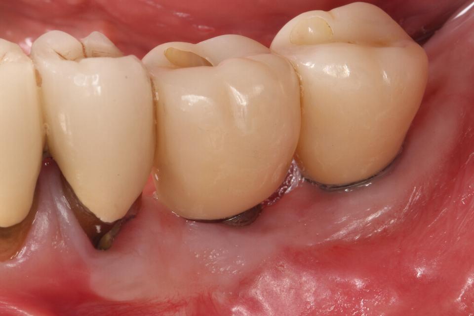 Fig. 2k: Acompanhamento de 5 anos após a cirurgia de ROG. Novas próteses implantossuportadas foram instaladas e a faixa de mucosa queratinizada pôde ser visualizada. Um resultado estável foi alcançado e mantido.