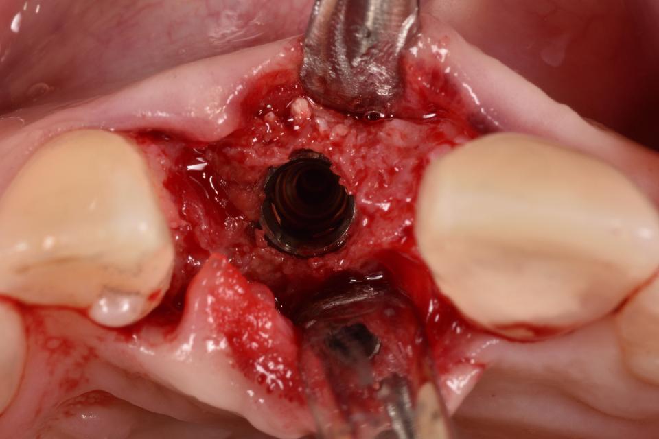 Fig. 22: Intra-operative situation with a dental implant placed in an ideal three-dimensional position