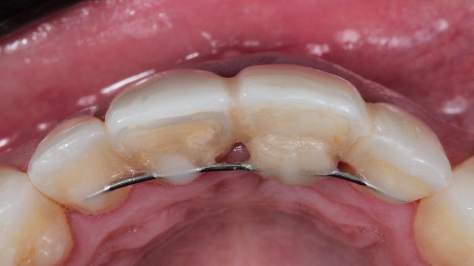 Fig. 2b: Technique mini-invasive pour l'extraction dentaire sans lambeau - vue occlusale à la ligne de base.