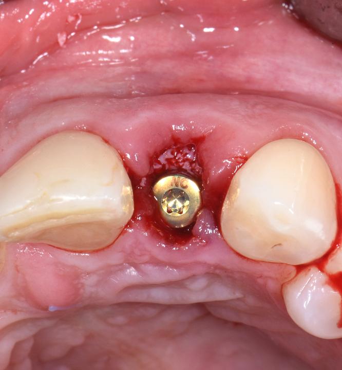 Fig. 2h: The peri-implant defect on the facial side of the implant was grafted with deproteinized bovine bone mineral (DBBM) (BioOss; Geistlich Pharma, Wolhusen, Switzerland) to the level of the facial bone crest