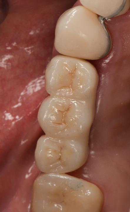 Fig. 7b: Vista clínica de un FDP de zirconia soportado por implantes con troneras vestibulares redondeadas y troneras palatinas/linguales con relleno