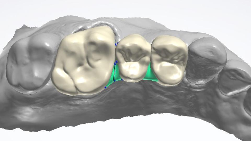 Fig. 7a: Aumento della superficie del connettore mediante rimozione degli spigoli palatali/linguali