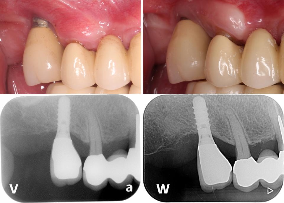 Fig. 3v – w: Confronto tra la fotografia intraorale e la pellicola radiografica prima dell'intervento (v) e quelle scattate 6 anni dopo l'intervento (w)