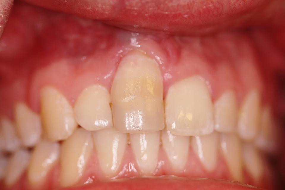 図4b: アンキローシス。右側上顎中切歯のアンキローシスの臨床像。重度の転位で、無傷の健常な隣接中切歯と比較して、唇側粘膜辺縁が臨床的に大きく移動している。歯冠切端部のコンポジットビルドアップを行い、切端のズレをマスキングしている。