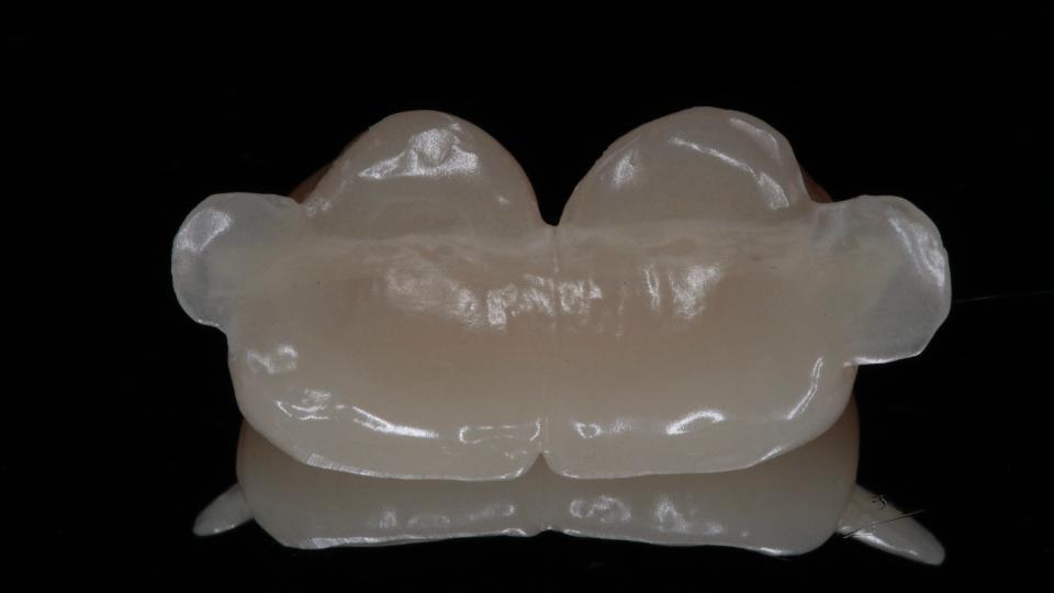 Fig. 8b: If immediate loading/restoration it is not possible, a provisional resin-bonded bridge may be an option during the healing period – palatal view