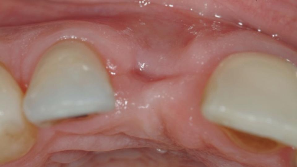 图. 11a: 骨块移植 + 4型种植: 牙槽嵴垂直向及水平向缺损