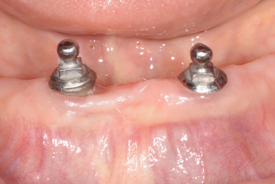 Fig. 2: An 83-year-old-female patient was visited 20 years after placement of two implants supporting an overdenture. Even though plaque control was not perfect, the implants are surrounded by a keratinized soft-tissue seal with no signs of inflammation