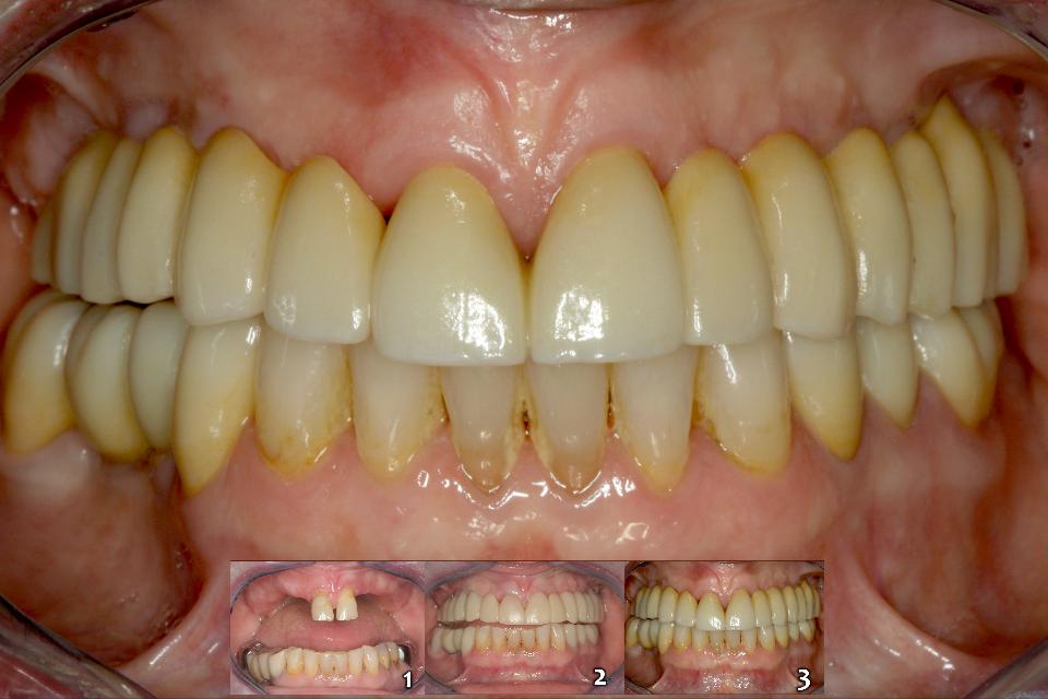 图. 6i: 第1优先级的临床选项是所谓的不借助义龈的“类天然牙固定修复”。(1:治疗前; 2:种植体植入和即刻临时修复; 3:戴入螺丝固位氧化锆修复体)