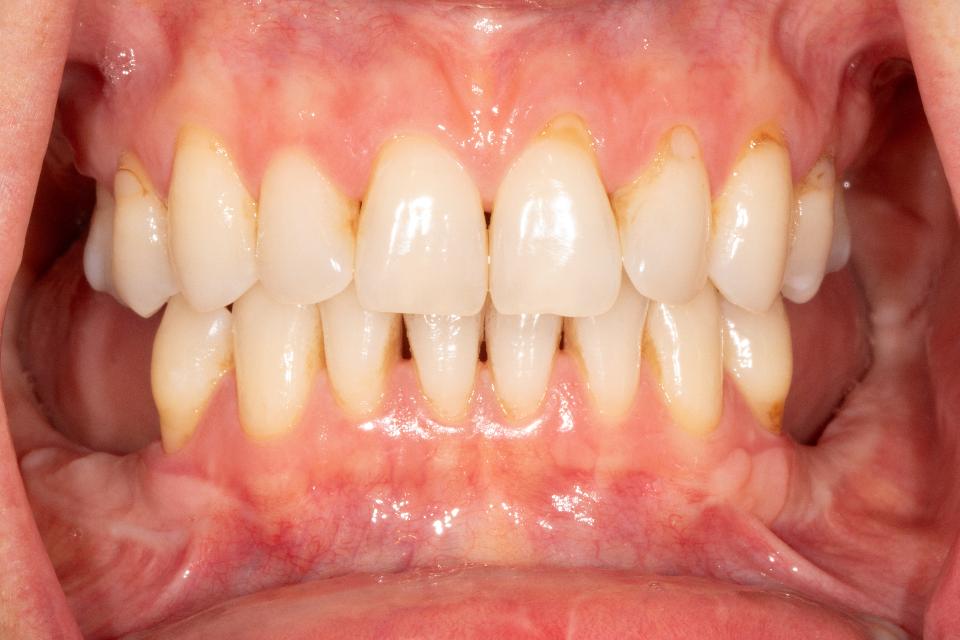 Fig. 1a: Clinical preoperative view showing posterior mandible vertical deficiency. Free gingival grafts were performed before bone grafting to improve the condition of the soft tissue