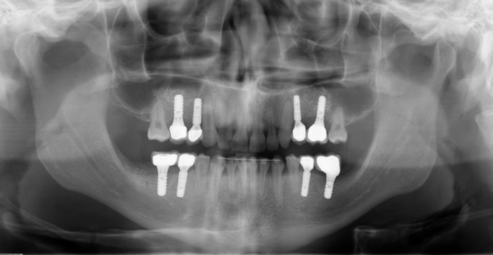 Fig. 5: Situación radiológica tras la colocación del implante