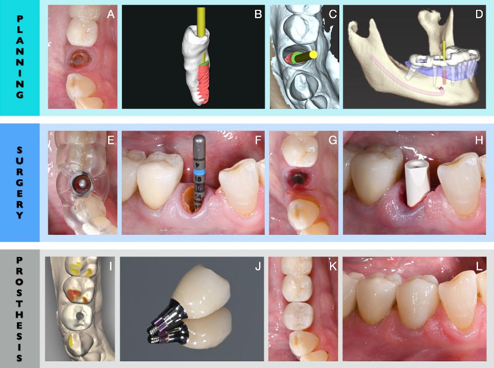 Fig. 5: Instalação imediata de implante e carga da posição do dente 44, planejada com o assistente coDiagnostiX AI. A:situação clínica inicial com o dente 44 fraturado do ponto de vista oclusal; B: extração virtual do dente realizada com o assistente de IA do software de planejamento de implantes CoDiagnostiX; C:simulação retroativa da instalação do implante com orientação protética (Straumann BLX 3,75 x 12 mm); D: Desenho digital do guia cirúrgico (CoDiagnostiX) para cirurgia de implante estática assistida por computador totalmente guiada [s-CAIS]; E: abordagem sem retalho minimamente invasiva com guia cirúrgico impresso em 3D e luva metálica mostrando o medidor de profundidade após a perfuração oclusal da broca piloto; F: Extração dentária seguida do protocolo de perfuração de implante guiado conforme planejado virtualmente com medidor de profundidade in situ; G: implante colocado com uma abordagem minimamente invasiva sem retalho; H: captura intraoperatória da posição final do implante em 3D com um scanner intra-oral após a colocação do implante totalmente guiado e estabilidade primária assegurada (50 Ncm); I: Desenho digital da restauração final do implante monolítico de ZrO2 (Straumann CARES Visual); J: pilar ti-base pré-fabricado (Straumann Variobase RT) unido à coroa monolítica fresada de ZrO2 produzida em um fluxo de trabalho digital completo sem modelos físicos; K: situação clínica oclusal com a restauração final do implante após 1 ano de carga; L: vista intraoral vestibular após 1 ano de carga