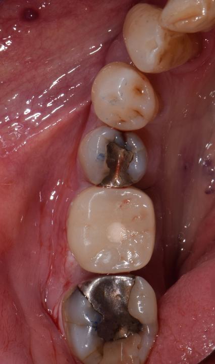 Şekil 5: Çekim anında implant yerleştirme gününde alt sol birinci azı diş bölgesinde karmaşık olarak sınıflandırılan ve dış kanıt Grup C ile sınırlı olan bir prosedürde yerleştirilen anında restorasyonun oklüzal görünümü (Samir Abou-Ayash’ın arşivinden alınmıştır).