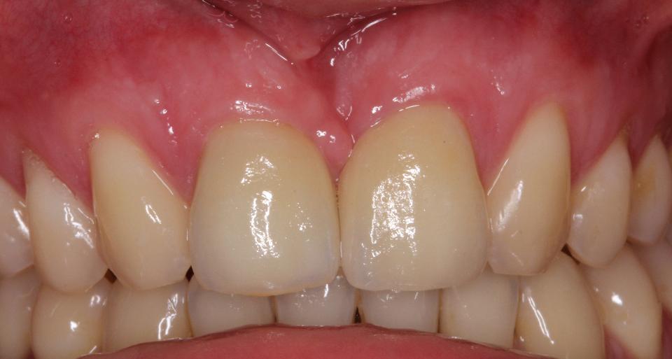 Fig. 5c: Chiusura ortodontica. Presentazione clinica dopo la mesializzazione ortodontica dell'intera dentizione superiore supportata da un dispositivo di ancoraggio temporaneo palatale (TAD) e dopo aver dotato 12 e 22 di corone in ceramica integrale