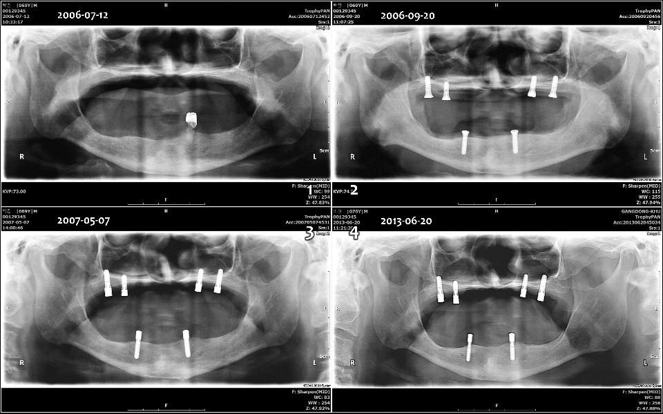 Fig. 13b: Overdenture magnética sobre 2-4 implantes pode ser fornecida para os maxilares edêntulos superior e inferior com encaixes magnéticos (Magfit-DX800, suporte de pilar único e domo, Aiichi Steel) que pode girar levemente durante a função, mantendo uma força magnética de 800gf (1 - 4). Na visão panorâmica, não houve reabsorção óssea crestal nos 4 implantes na maxila e nos 2 implantes na mandíbula desde 2006 até hoje.