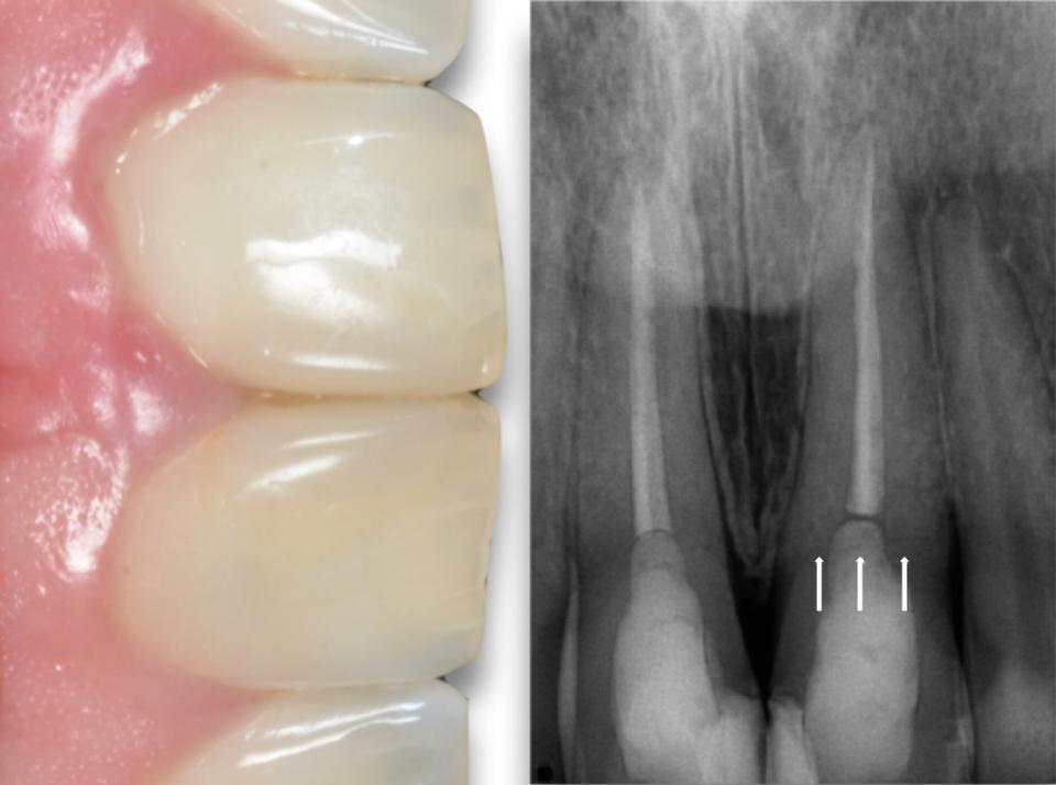 Fig. 13a: Early implant placement in the ideal three-dimensional position with simultaneous soft and hard tissue reconstruction leads to peri-implant health and satisfying esthetic outcomes