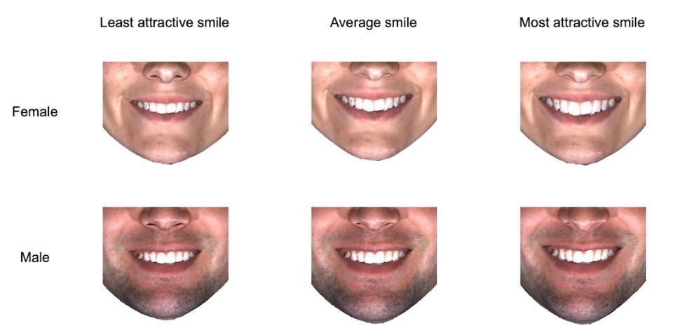 図5: 平均的な女性と平均的な男性の笑顔の表面形状を、自己認識される笑顔の魅力に応じて示したもの。より魅力的な笑顔は、魅力的でない笑顔に比べ、より多くの歯が露出しているため、幅が広い。
(注）図中の表面画像は、実際の人物を描いたものではない。TPS変換とランダムなテクスチャーの選択により作成された平均あるいは極端な形状のものである。実在の人物との類似性はランダムであると考えられる。 
